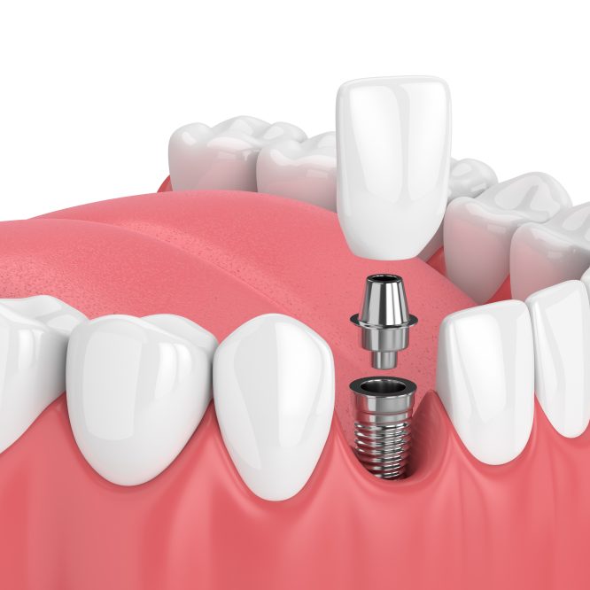 Missing teeth dont have to cost the earth